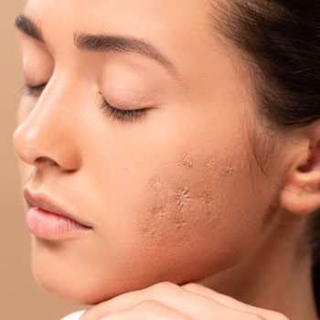 young woman with closed eyes and acne on face isolated on beige